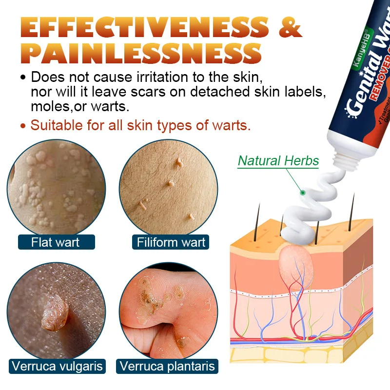 Kanyehb Verruca Verwijderen Crème Ping Aap Je Verruca Verwijderen Crème 20G