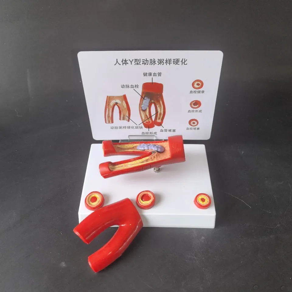 

Cardiovascular and cerebrovascular blockage model fat pathological atherosclerosis human anatomy teaching aids