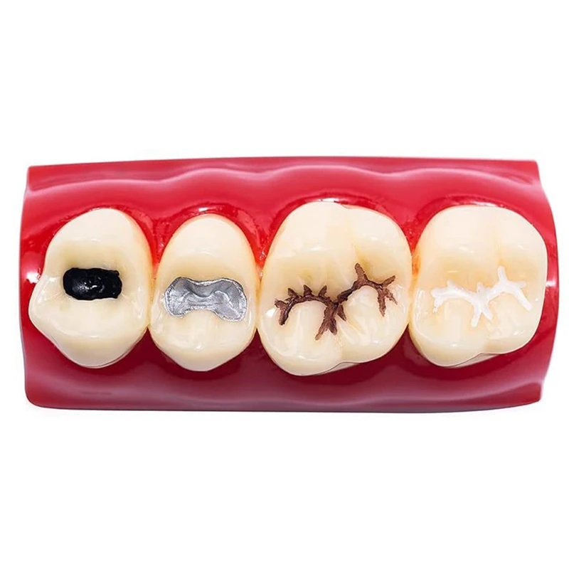 Pathology Teeth Model Sealant Demonstration Tooth Model For  Teaching,Displaying, Educating