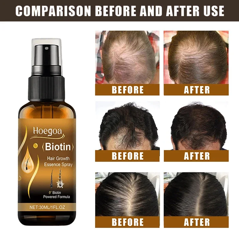 Thumbnail 4 - #42 Compare Hair Loss Treatments Before You Buy