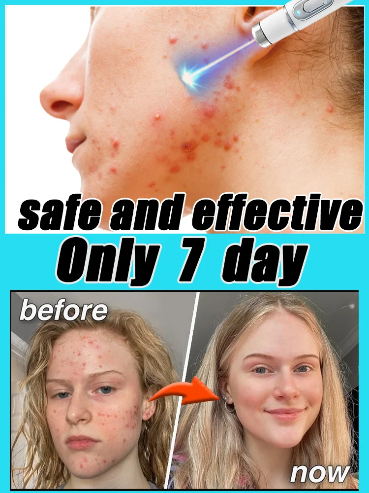 Acne Disappears Instantly