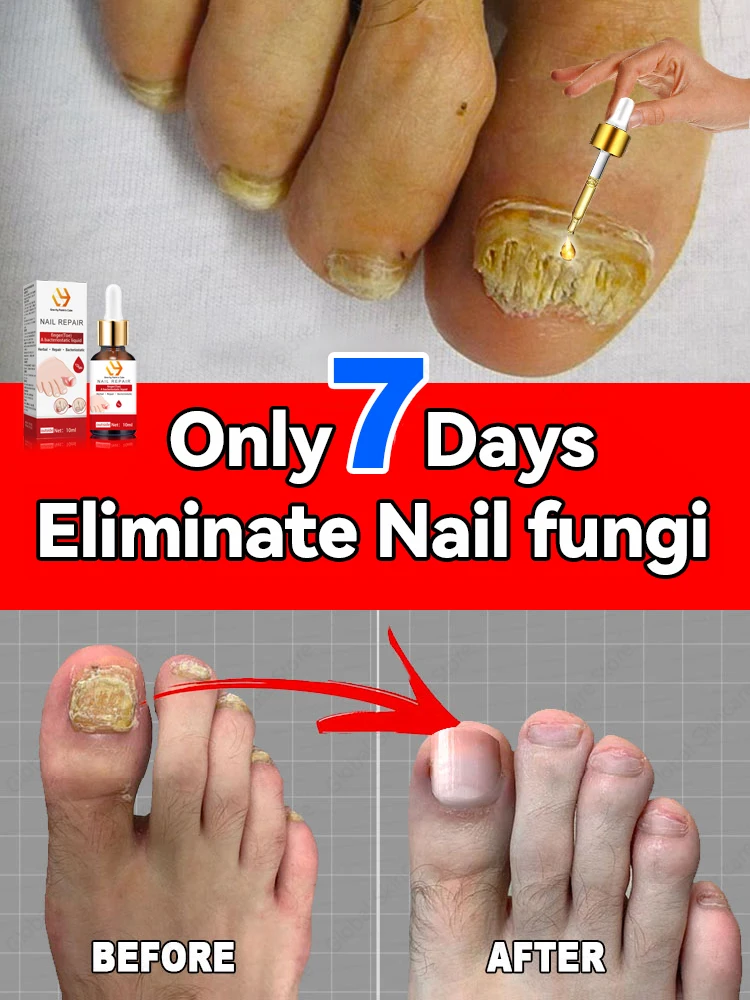 Nail fungi Problem product