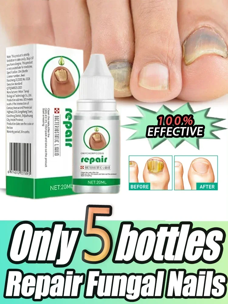 

Fungal Nail Treatment Oil Foot Repair Essence Toe Nail Fungus Removal Gel Anti Infection Cream Fungal Nail Removal Paronychia