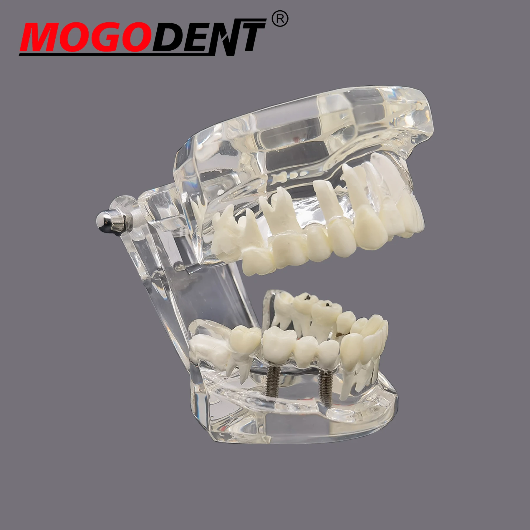 Tooth Model Dental Teaching Models Doctor Patient Communication Teeth Implant Model Dental Resin Tooth Eental Model Dental Lab