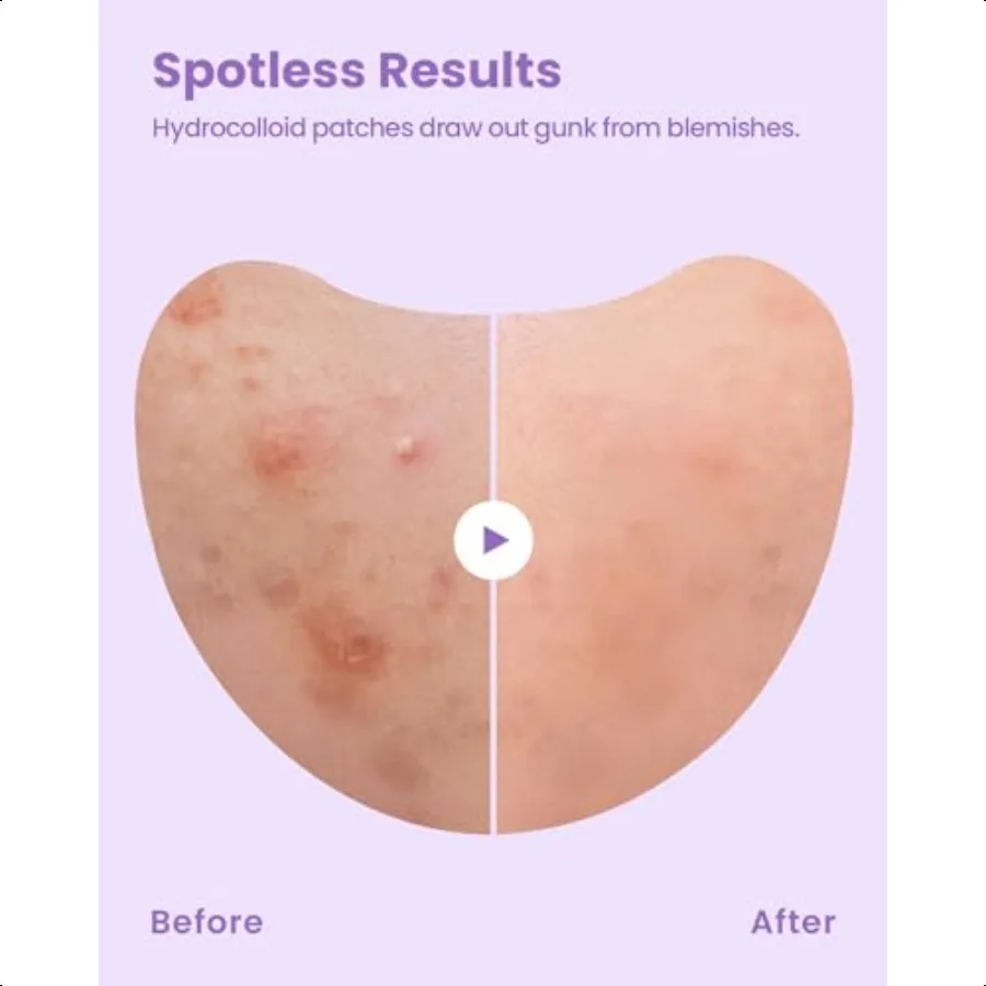 Spotl Patch Hydrocolloid Spot Patch for Wide Acne area Cheek Body Blackhead Cruelty Free and Vegan Friendly 12 Count