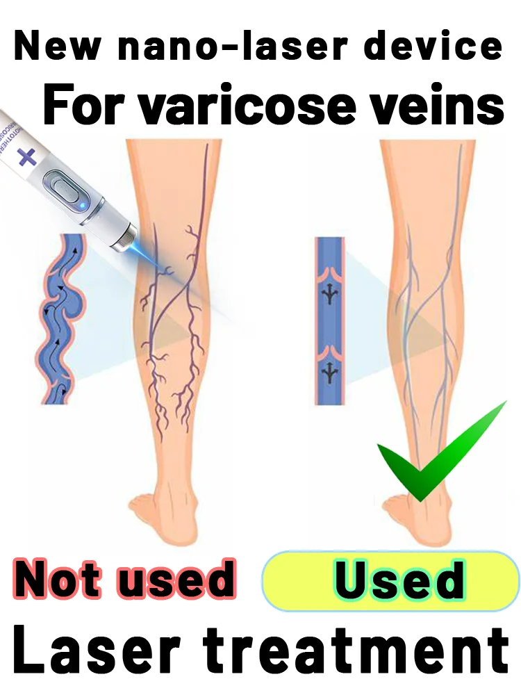 

Special offer for nano laser device for varicose veins and spider veins