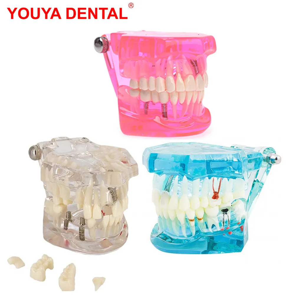 Dentistry Implant Dental Models For Patient Education Communication Dentist Medical Science Macro  Teeth Model Studying Teaching