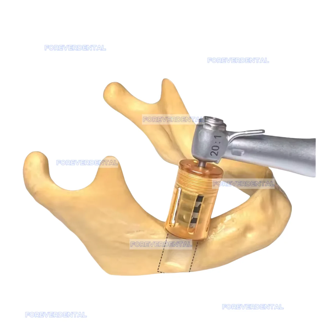 

Dental Implant SLT Half Moon Bone Drill Implant Ring Drill Used for Incremental Bone Implantation Surgery To Extract Flake Bone
