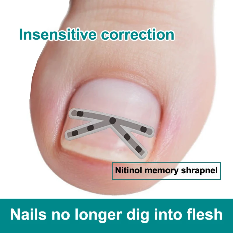 

【W】1Pcs Ingrown Toenail Correction Tool Ingrown Toenail Treatments Elastic Patch Sticker Toenail Straightening Pedicure Tool