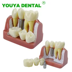 Dental Implant Teeth Model 4 Times Dentistry Teach Implant Analysis Crown Bridge Removable Model Dentist Demonstration Tool