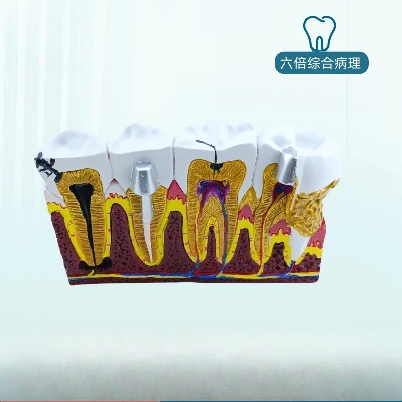 Comprehensive pathological model Adult periodontal, sectional tooth model, pathological dental nerve