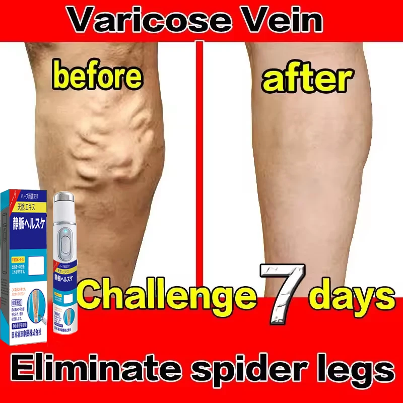 Generacja Laserowa Trzecia na Żylaki - Laserowy Punktator do Leczenia Eliminuje Zapalenie Naczyń i Żylaków, Łagodzi Ból Pajączkowych Nóg