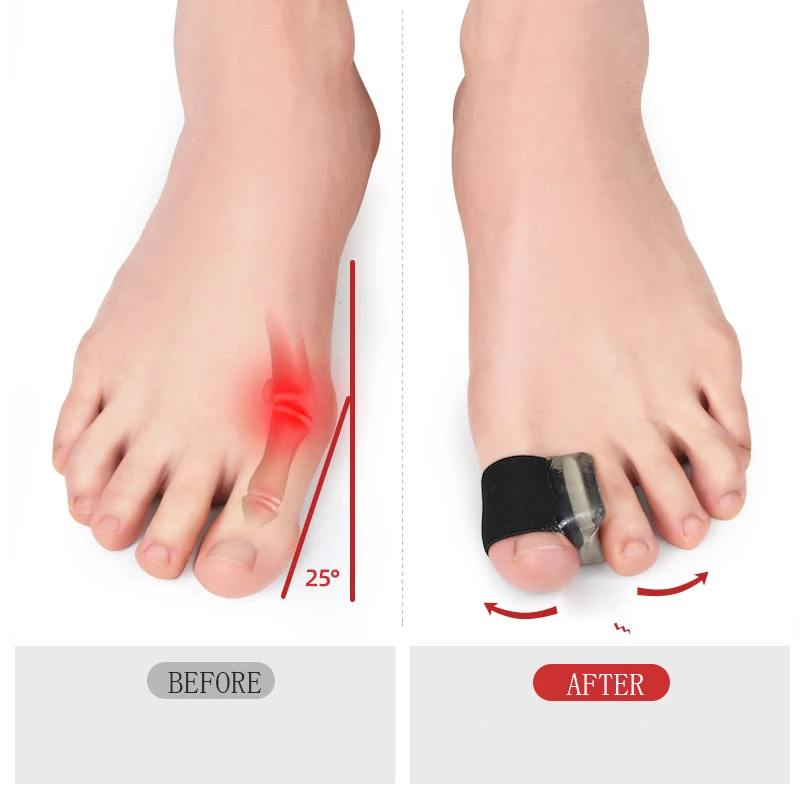 2 SZT. Duży Separator Palucha Koślawego Szyna Korektor Prostownik Narzędzia do Pielęgnacji Stóp Ochraniacz na Haluksy Orteza 1 Para