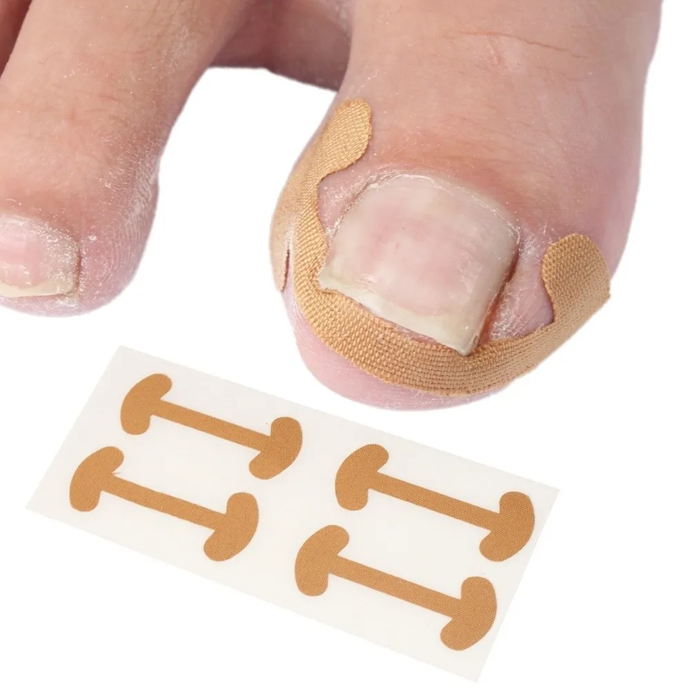 Parche corrector de uñas encarnadas transpirable, pegamento de algodón elástico, alisado físico, herramienta de pedicura, 20 piezas
