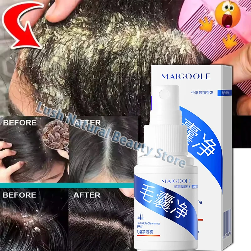 

Быстрая отшелушивающая сыворотка для удаления перхоти, средство против зуда, средство для борьбы с себорейным маслом для кожи головы, очищает, восстанавливает уход за кожей головы