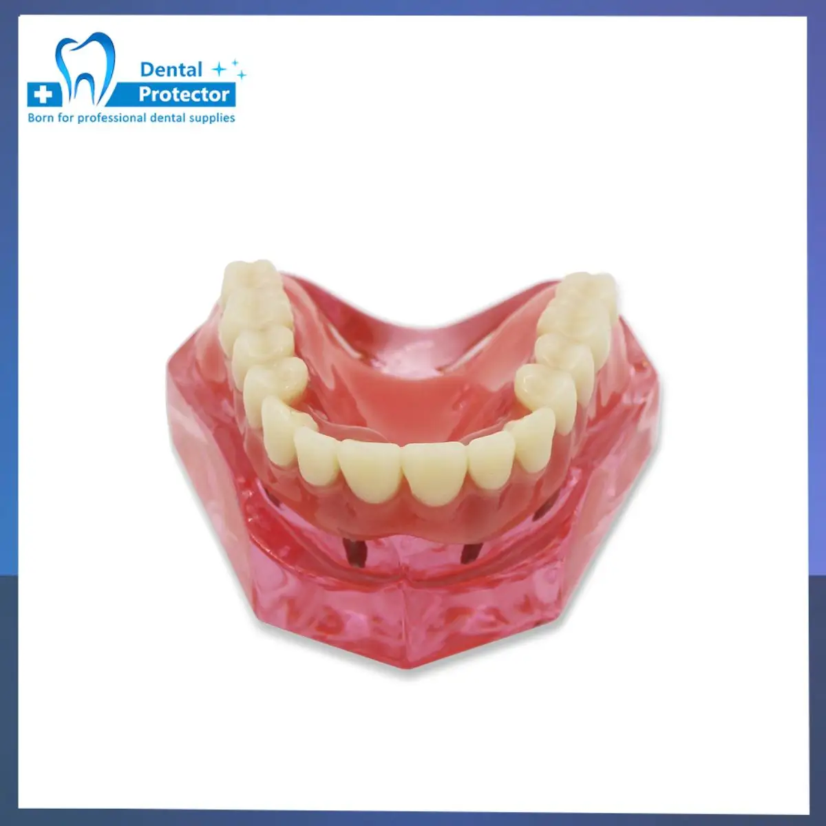 Dental Teeth Model With 4 Implants Overdenture Restoration Bridge For Dentist Implant Treatment Demo Teaching Model