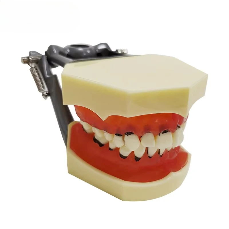 

Модель пародонтальной твердой десенной патологии с камнем