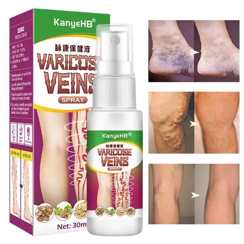 Spray de soin des varices à base de plantes, soin des varices, phlébite et angiite de Charleroi, inflammation des veines sanguines, veines d'araignée, 30ml