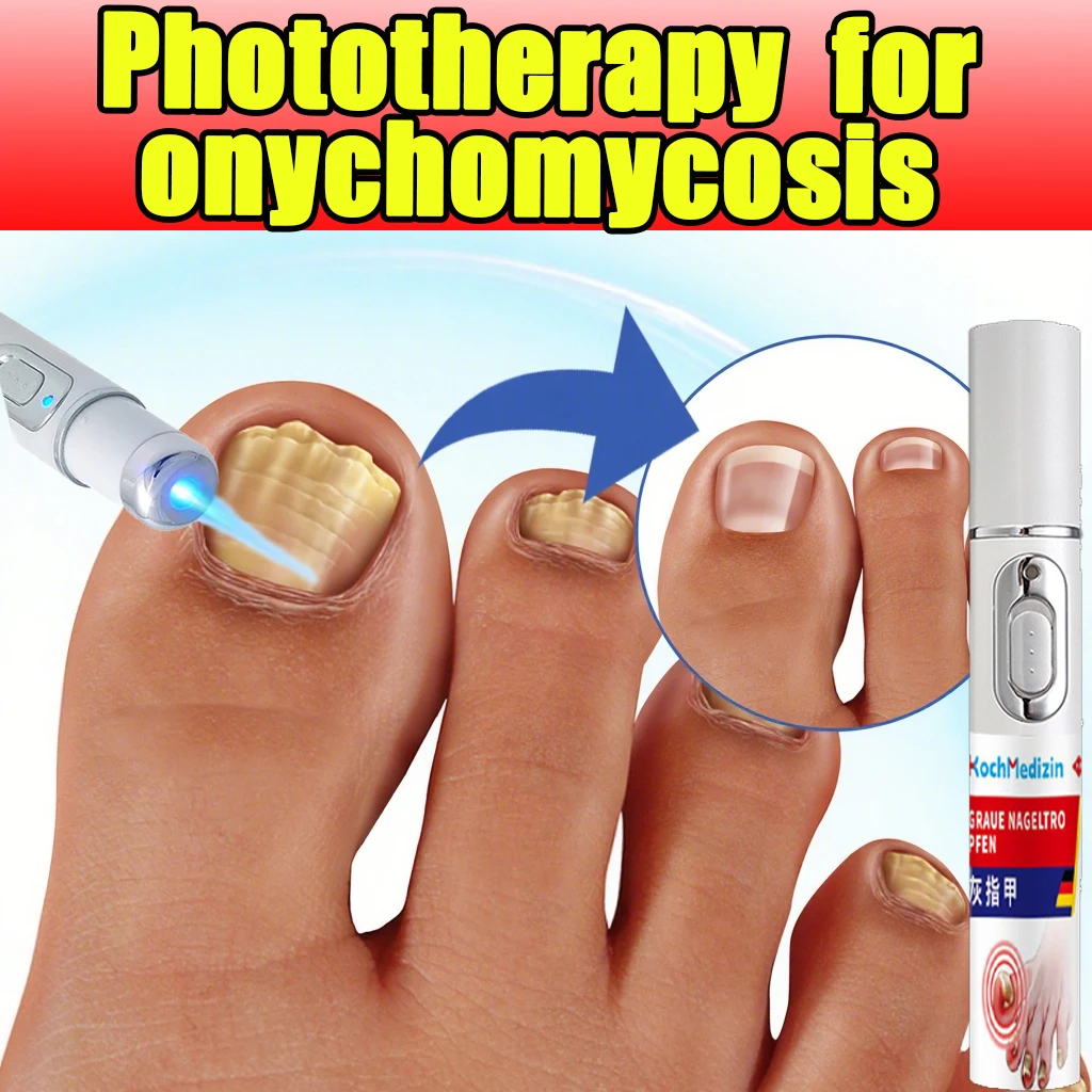 

Fungus nail laser pen helps to get rid of onychomycosis gray nail Painless and long-lasting sterilization anti-recurrence