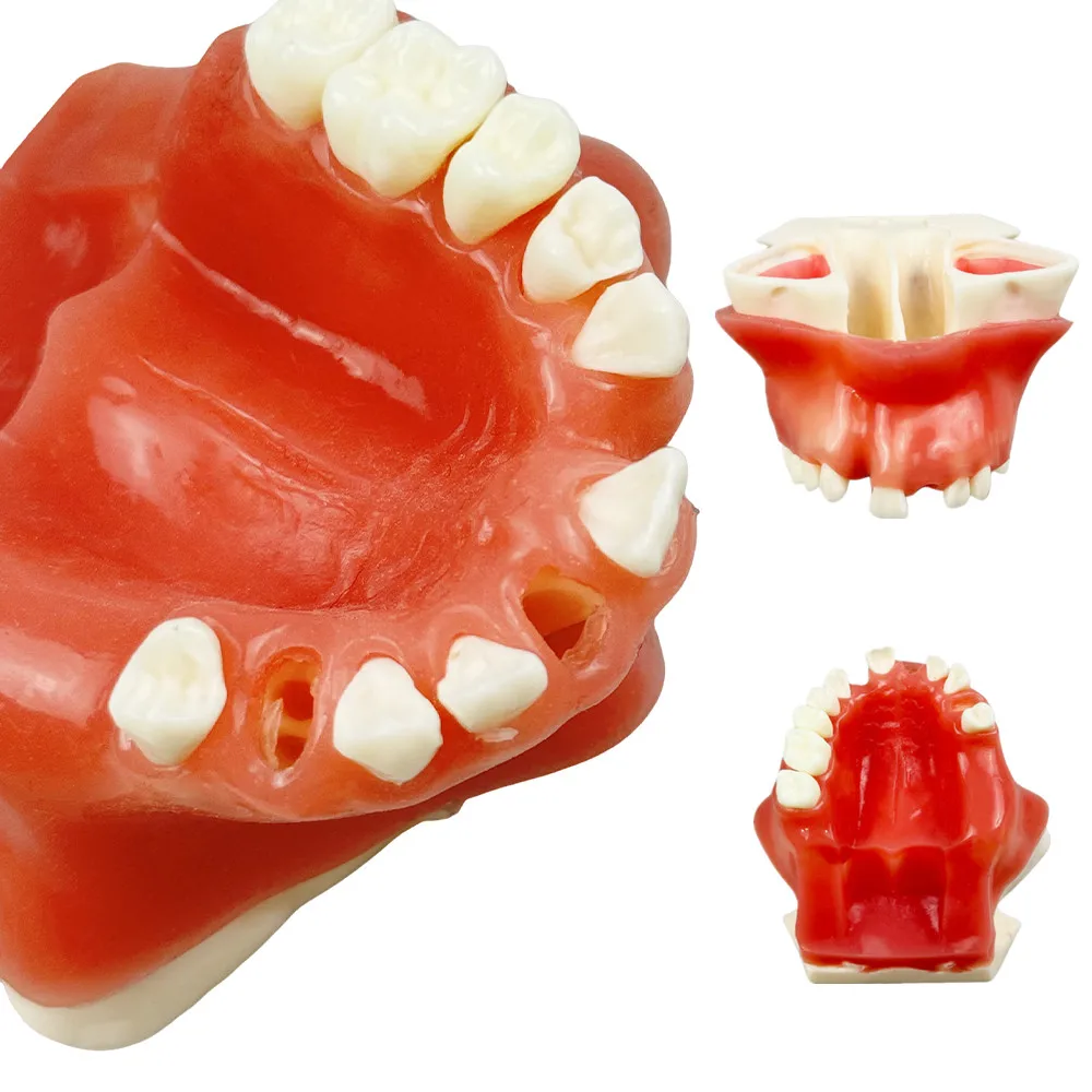 

Dental Implant Model Missing Tooth Maxillary Sinus Training Model Upper Jaw Implant Practice Teeth Model For Student Studying