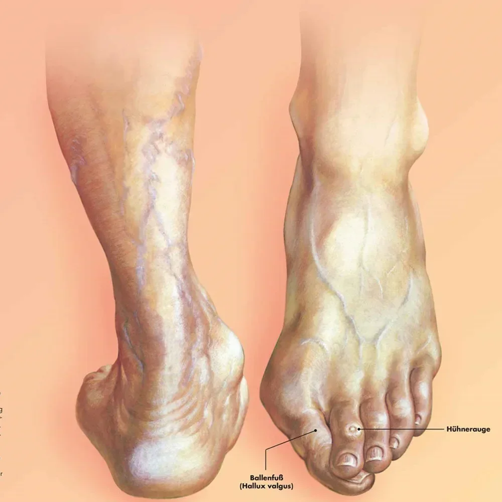 Foot malformations Vintage Kraft Paper Wall Art Painting Human Anatomy Medical Posters & Prints Wall Stickers Home Decor Chart