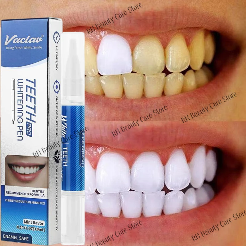 قلم تبييض الأسنان قلم تبييض الأسنان الأبيض المبهر قلم تبييض الأسنان الفوري أدوات العناية بصحة الأسنان #1