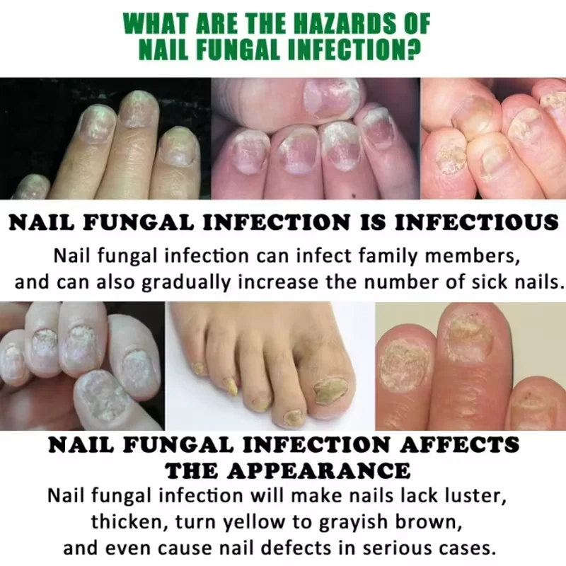 7 Days Nail Fungal Treatment Essential Oil Foot Toe Nail Fungus Removal Serum Repairs Onychomycosi Anti Infection Care Products