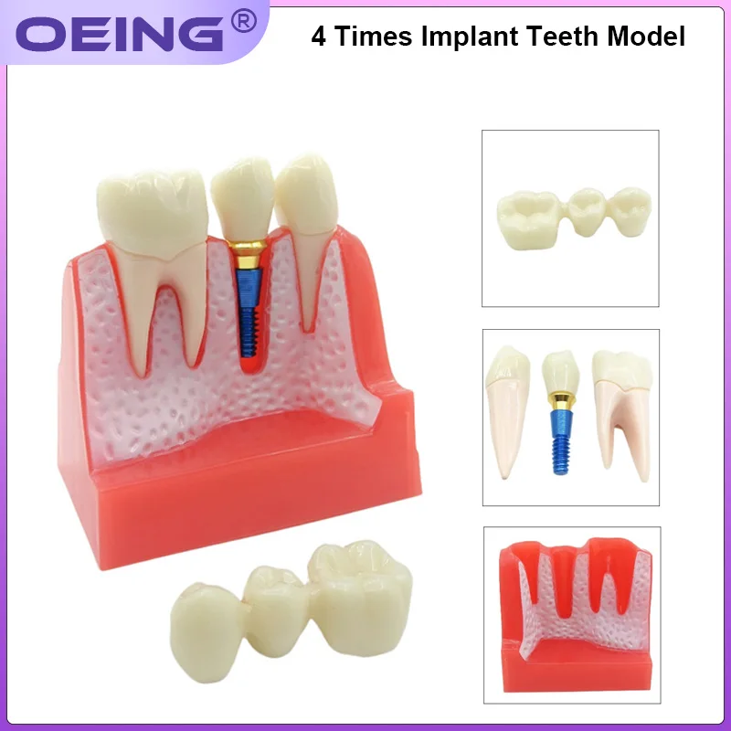 1Pc Dental Implant Teach Crown Bridge 4 Times Teeth Model Implant Removable Model Porcelain Teeth Model For Dentist Teaching