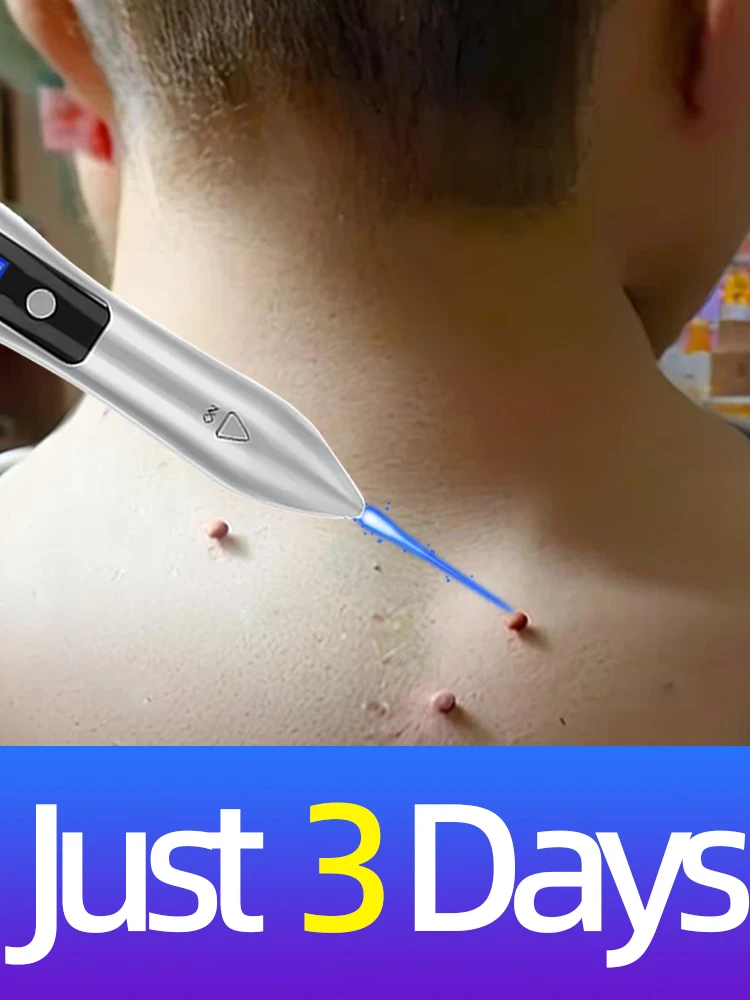 Blue Light Pen Solve Wart Tool