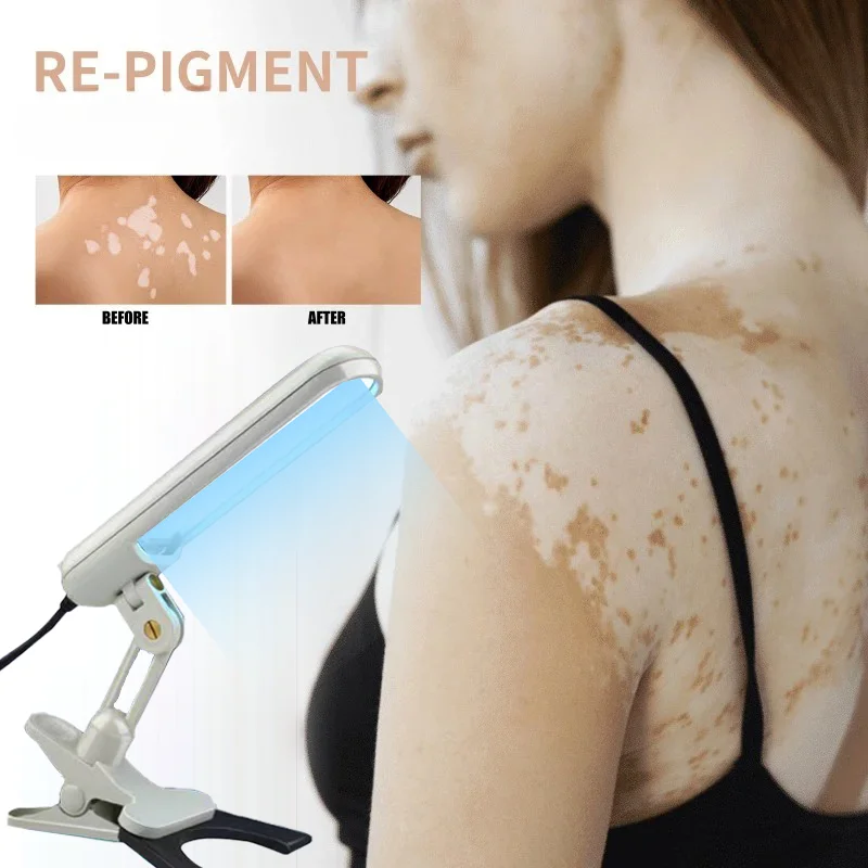 

308nm UVB Ultraviolet Phototherapy UV Lamp Instrument for Vitiligo Psoriasis Skin Disease Treatment and Therapy Treatment Light