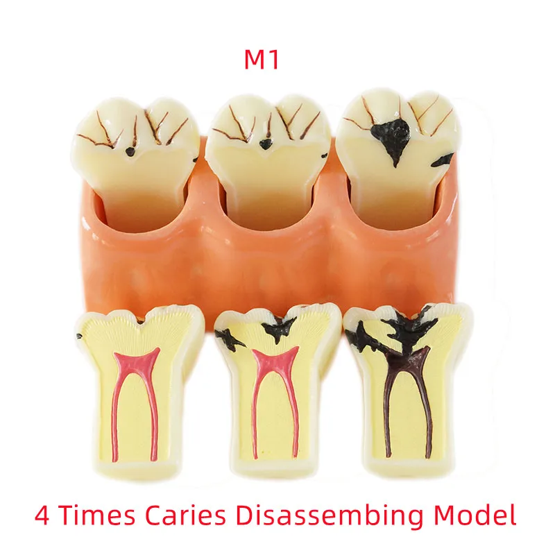 Dental Teaching Model 4/6 Times Caries Disassembling Comparations Implant Model Dentistry Tool Laboratory