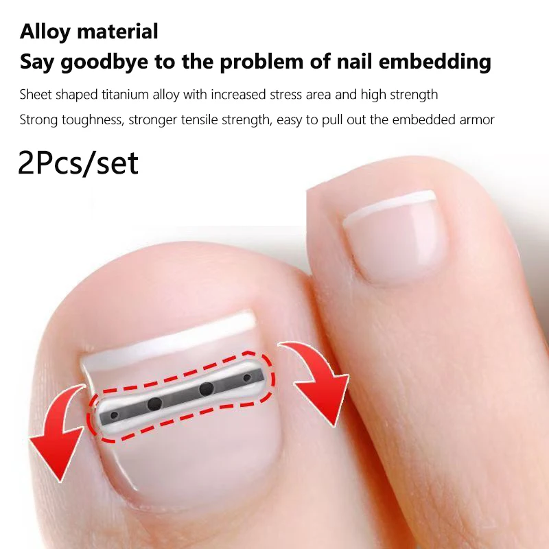 【2Pcs Ingrown Toenail Corrector Tools Pedicure Recover Embed Toe Nail Professional Ingrown Toenail Straightening Clip Brace】