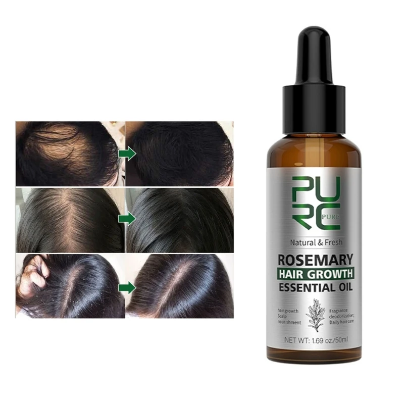 Aceite de romero, tratamientos anticaída de cabello de crecimiento rápido para el cabello, prevención del cuero cabelludo, nuevo