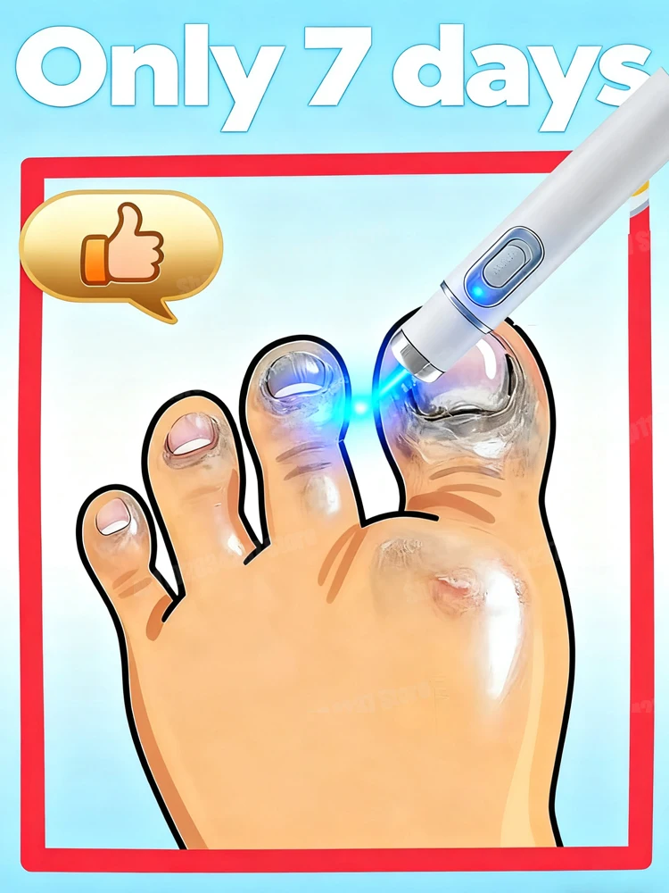 La quinta generazione di penna laser per unghie color champagne aiuta a rimuovere il fungo delle unghie, la sterilizzazione incolora e di lunga durata1