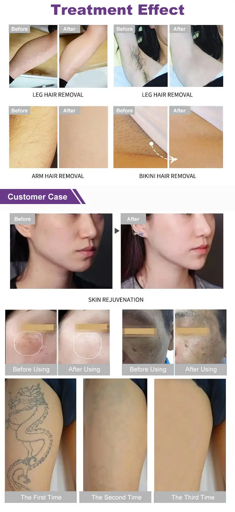 Professional 2 In1 808nm Diode Hair Removal Skin Rejuvenation YAG Lasers Tattoo Removal Machine view 6