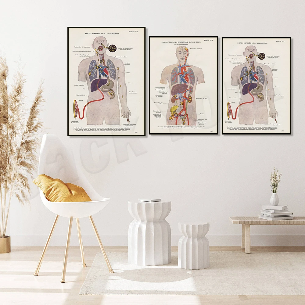 Medical tuberculosis print from 1952, tuberculosis anatomy poster, gift for doctor office decoration pulmonary department