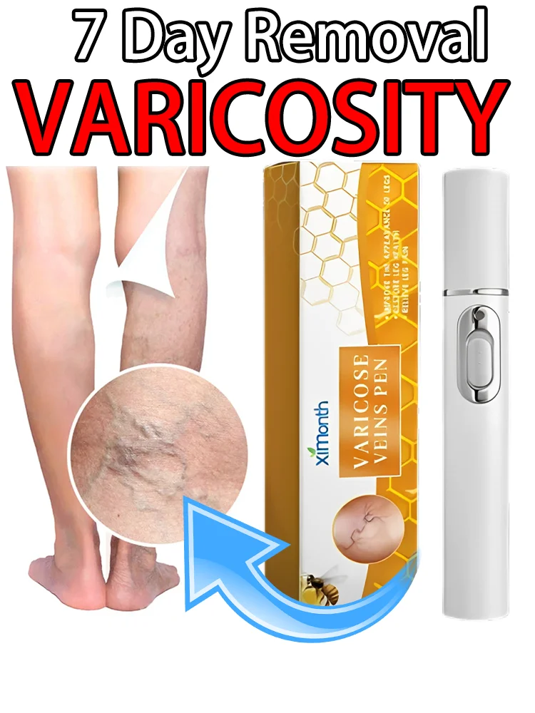 

Varicose Veins Laser Therapy Pen For Men And Women Relieve Leg Pain Improves Varicose Vein