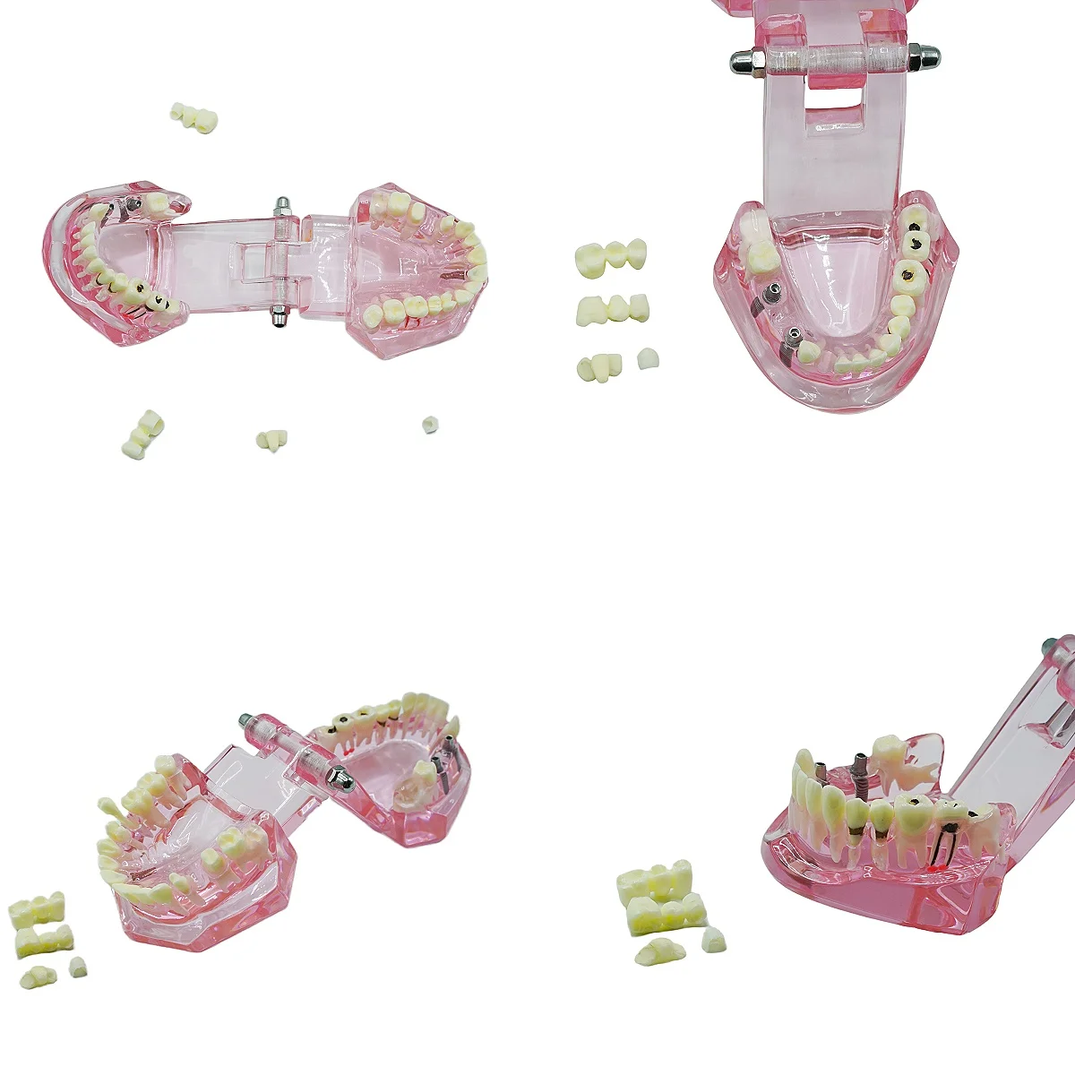 1PC Dental Implant Training Model Removable Teeth With Pathology Demo For Bridge Restoration Implant Practice Teaching