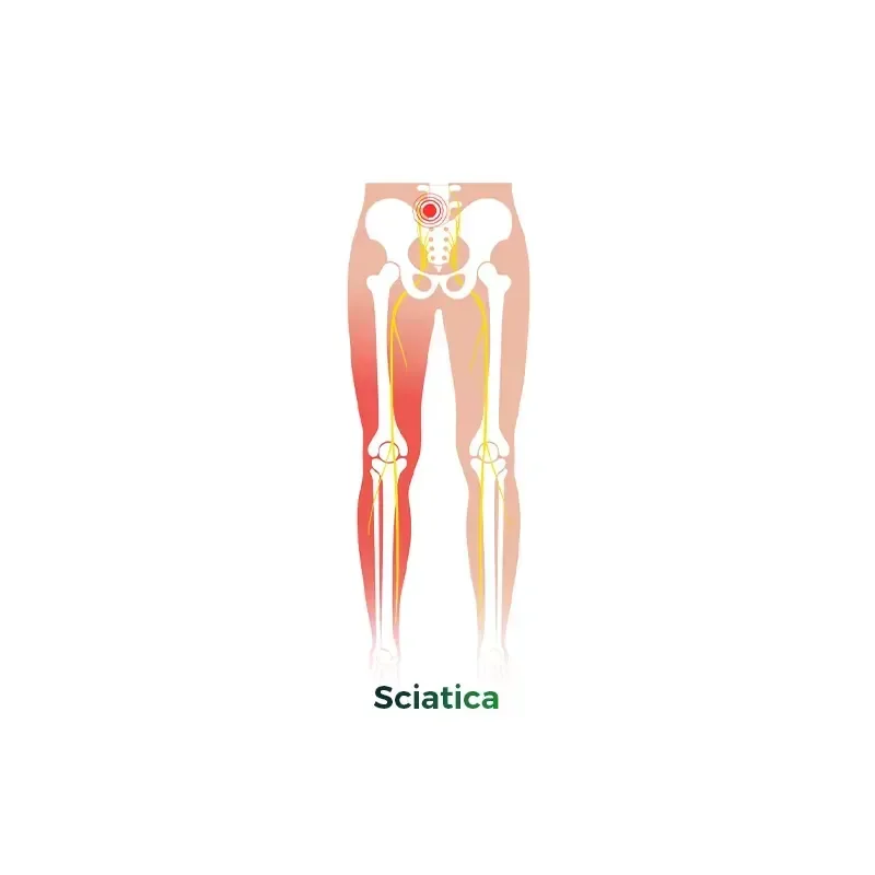 Chinese Manufacturer Shockwave Scraping Therapy for Sciatica with Online Technical Support