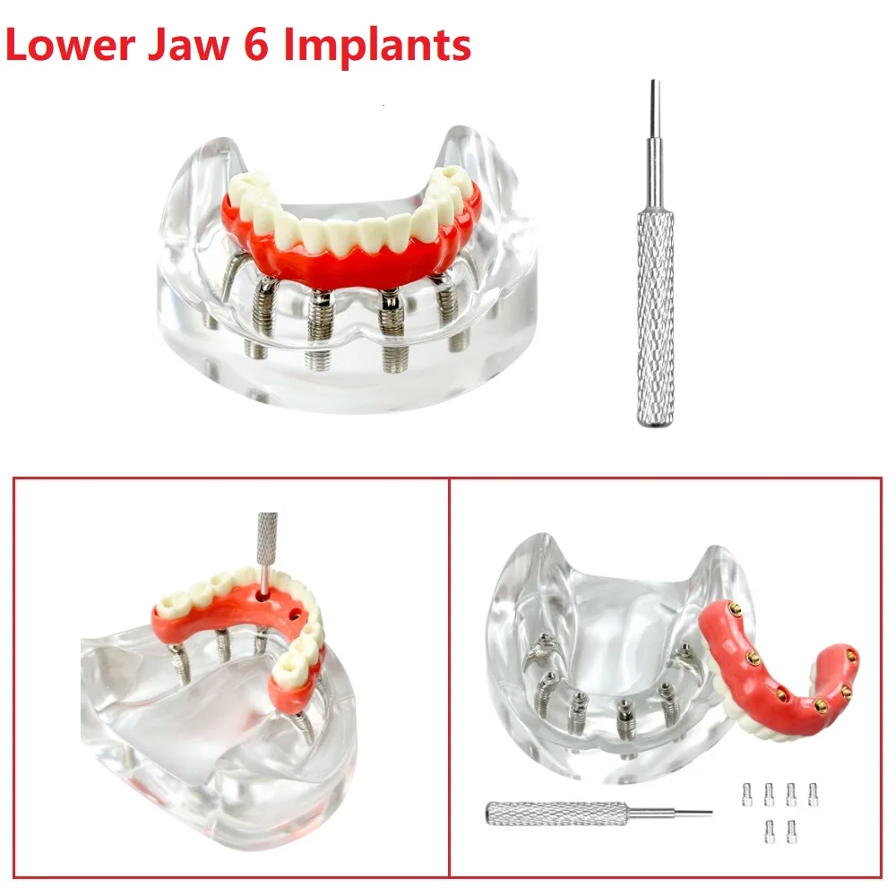 4-6-implants-dental-model-overdenture-restoration-model-removable-teeth-model-upper-lower-jaw-with-implant-screwdriver-for-teach