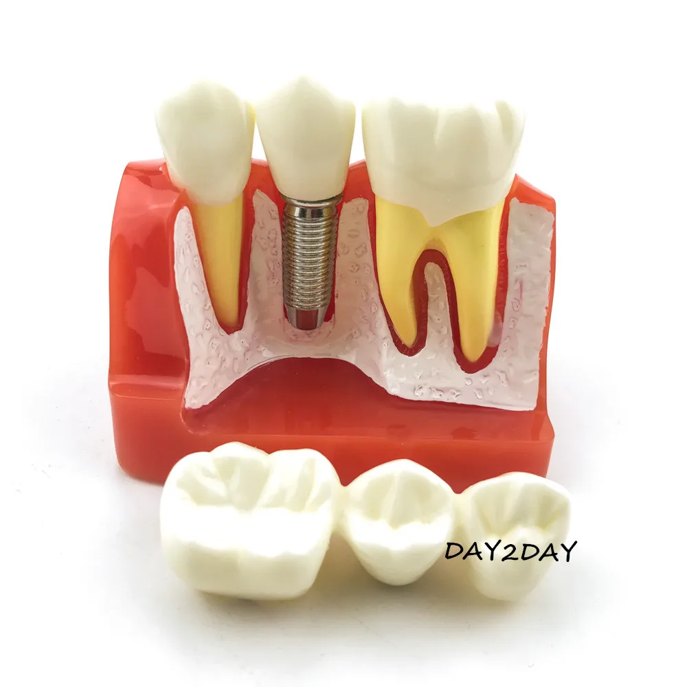 نموذج تعليمي عن طريق الفم # 2017X نموذج قابل للإزالة لجسر التاج لتعليم الأسنان نموذج لشكل الأسنان