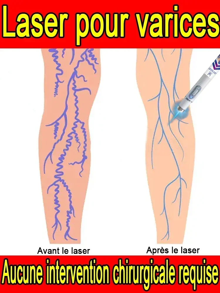 

04QSH Лазер для варикозного расширения вен 2-го поколения устраняет васкулит и флебит, снимает боль в паукообразных ногах, лазерная указка для лечения