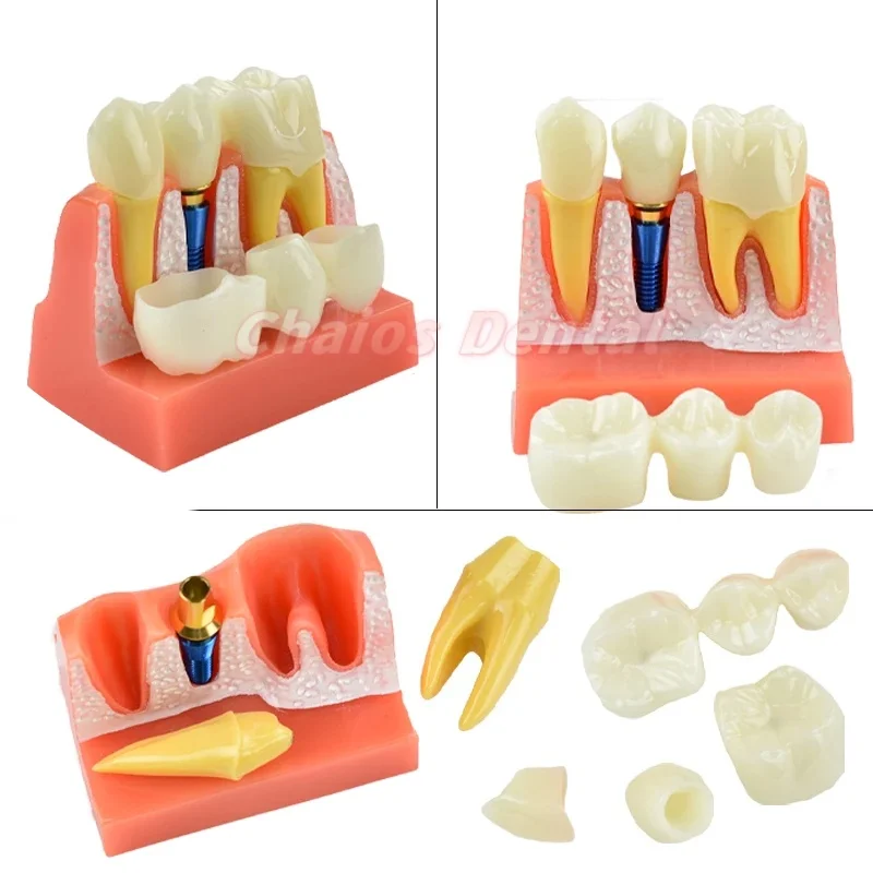 

1Pcs Dental 4 Times Implant Teeth model Analysis Crown Bridge Demonstration Removable Model Dentist Teaching Training Model