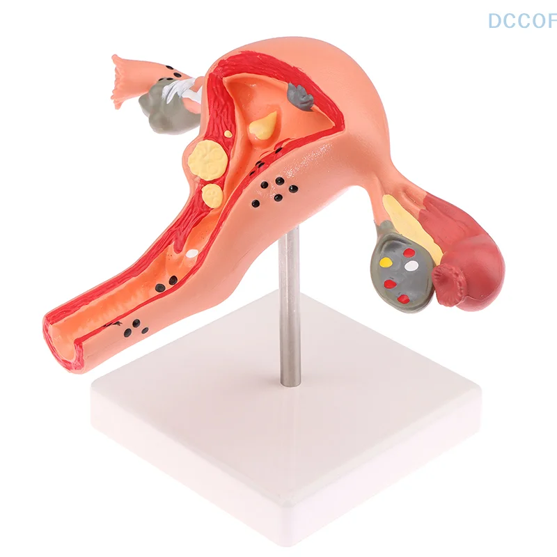 1Pcs Medical Props Model Pathological Uterus Ovary Anatomical Model Anatomy Cross Section Study Tool