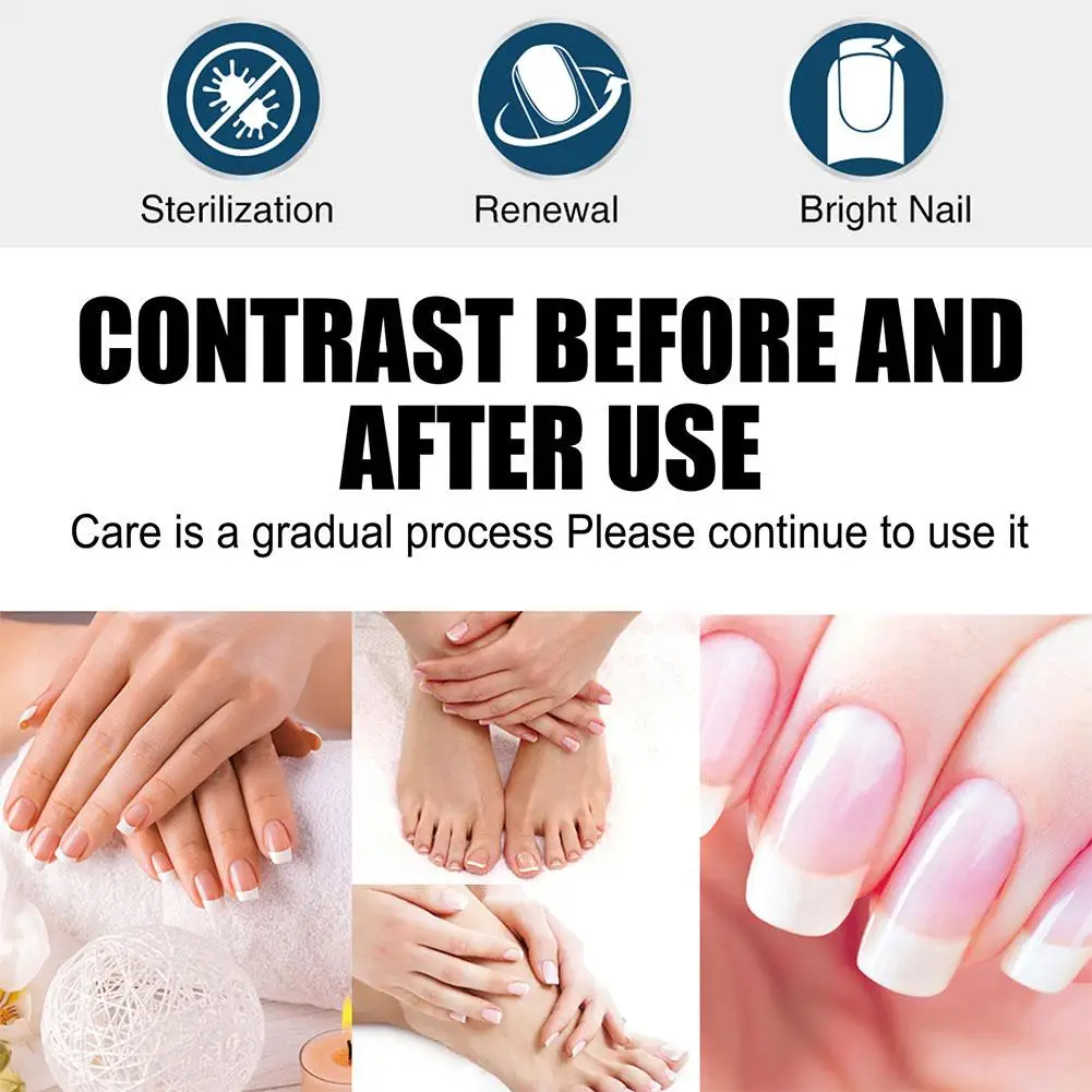 Nail Repair Liquid Pen Nail Fungus Treatment Serum Removal Nails Repair Infectio Liquid Fungal Cream Anti Toe Foot Gel R1O4