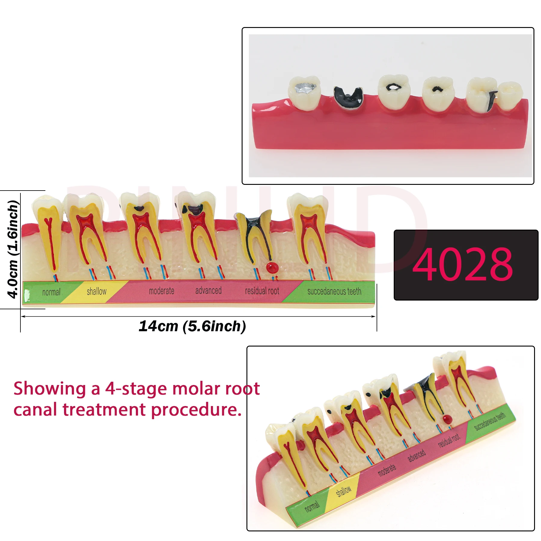 

Dental Caries Classify Tooth Model of Pathological Process Around Teeth Caries Evolution Decayed Model Dentist Lab Tool M4028