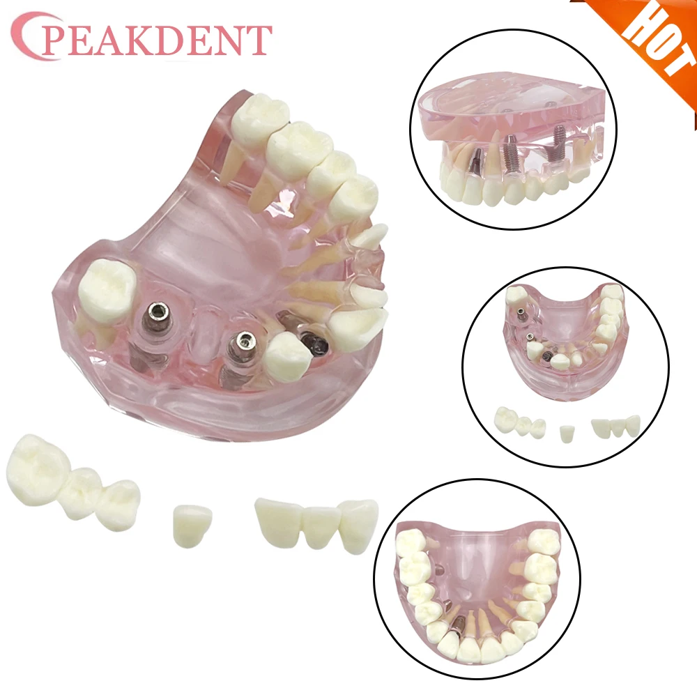 Dental Implant Mode… - image