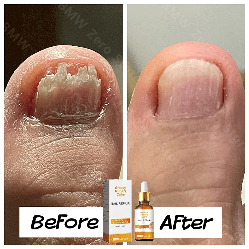 

NewToenail Nail Fungus Treatment Repair Fingernail Device Toenail Treatment for Foot Nail Fungus Essential Onychomycosis Ca