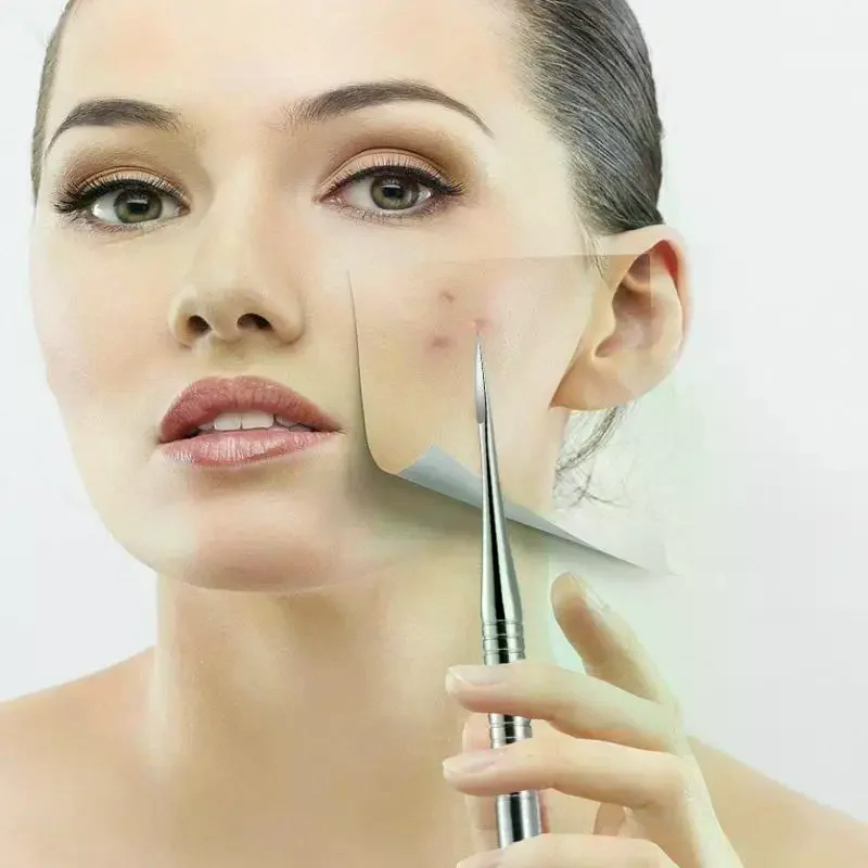 Pince à points noirs pour boutons cellulaires Ultra-fins, pour Salon de beauté professionnel, élimine les particules d'acné, outil d'aiguille, outils de beauté