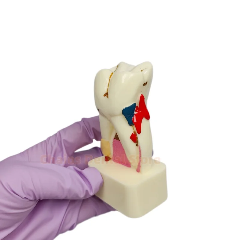 4X Enlarged Pathological Tooth Model M4015 Periodontal Disease Communication&Patient Education Model Dental Teaching Teeth Model